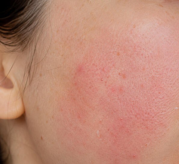Photo of a facial rash from mixing the wrong face products.