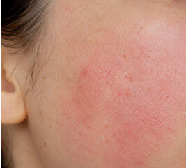 Photo of a facial rash from mixing the wrong face products.